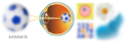 Bad vision